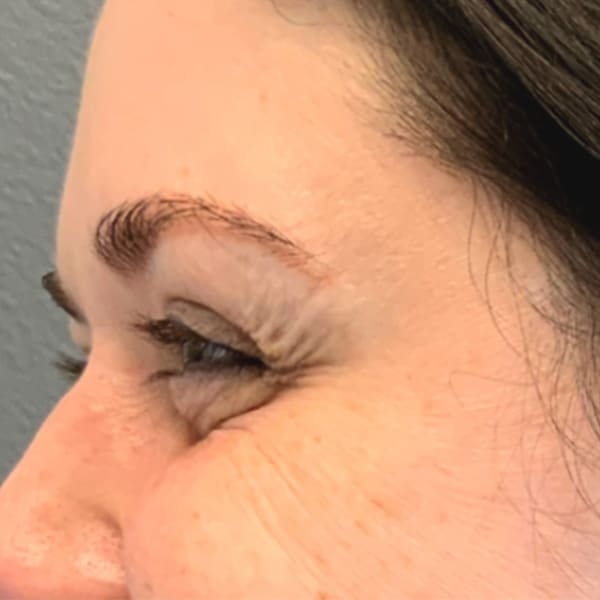 Botox® & Xeomin® 26 After