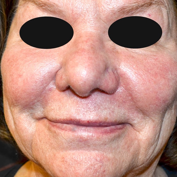 BBL® HERO™ 11 IPL Treatment Before
