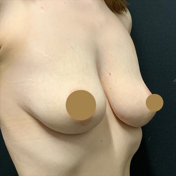 Vampire Breast Lift Before and After | Before