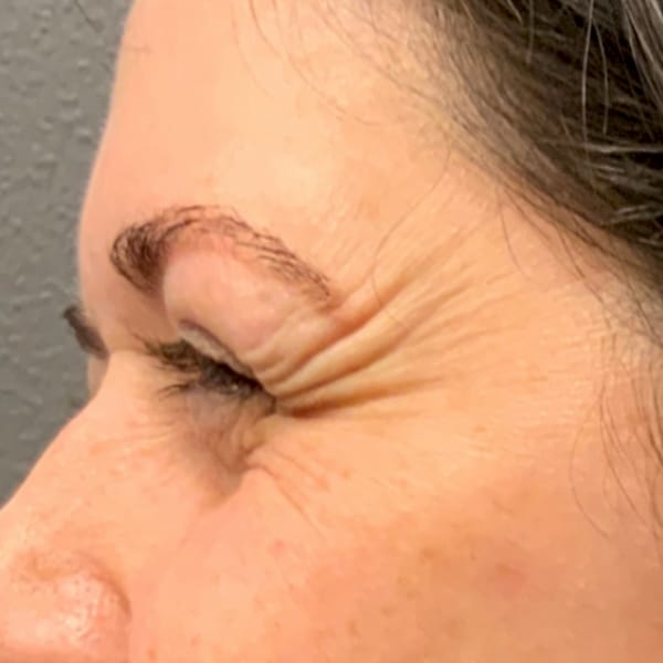 Botox® & Xeomin® 25 Before