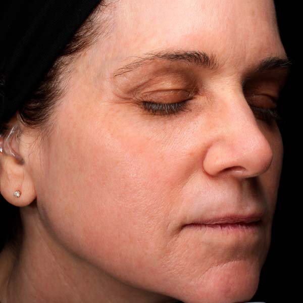 Laser Resurfacing 6 After