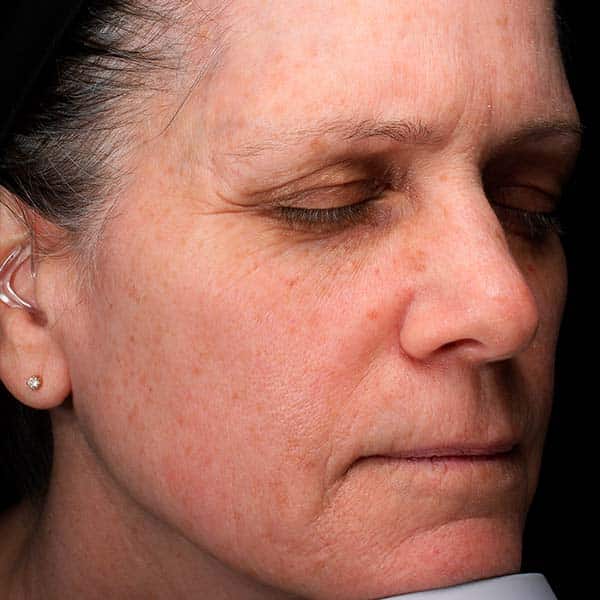 Laser Resurfacing 5 Before
