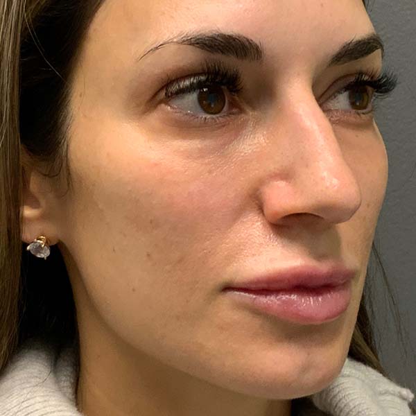Sculptra® Aesthetic Gallery 12 After