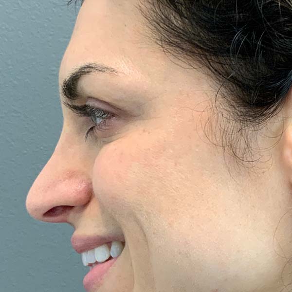 Botox® & Xeomin® 32 After