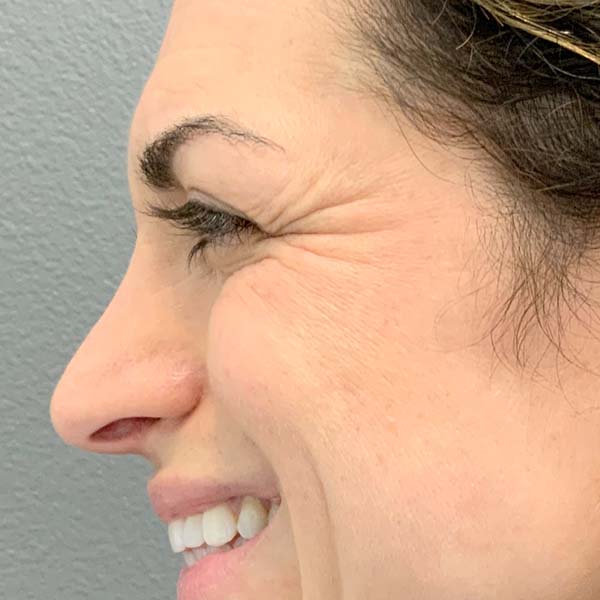 Botox® & Xeomin® 31 Before