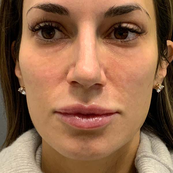 Sculptra® Aesthetic Gallery 10 After