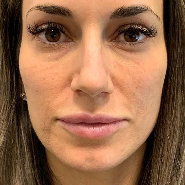 Sculptra® Aesthetic Gallery 9 Before