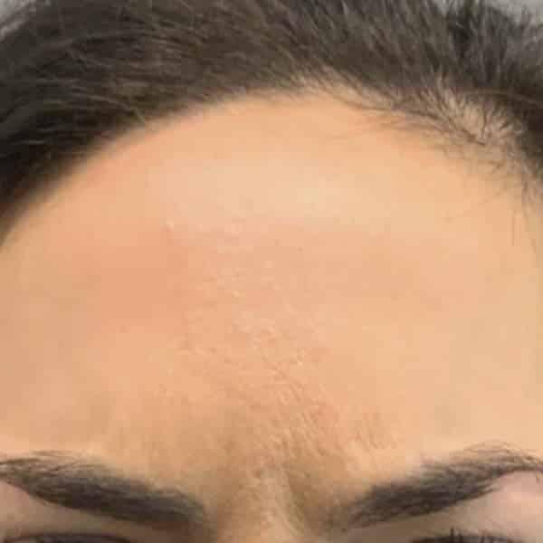 Botox® & Xeomin® 30 After