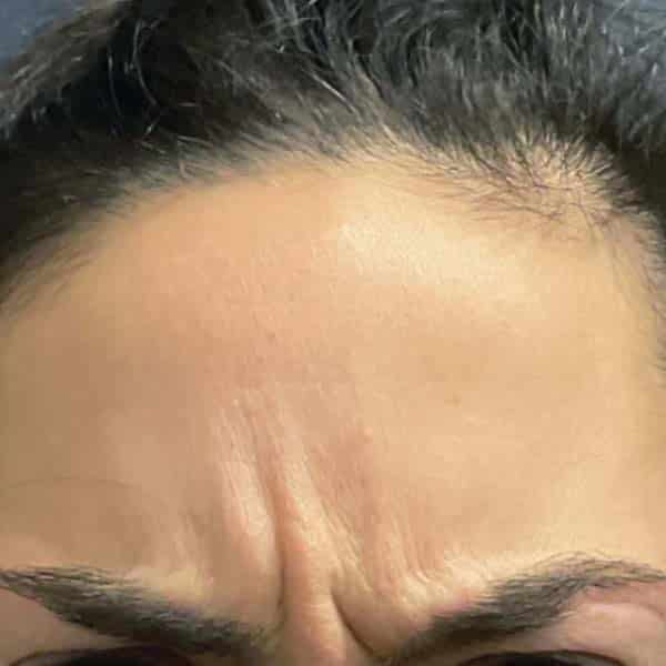 Botox® & Xeomin® 29 Before