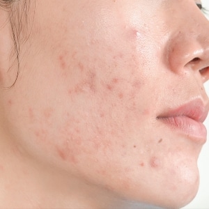 faces with acne vulgaris