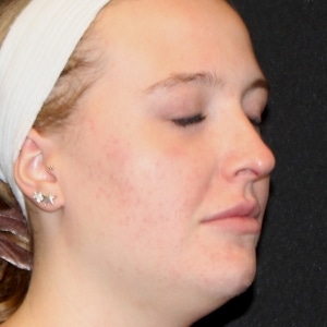 Woman's face after her Agnes RF acne treatment.