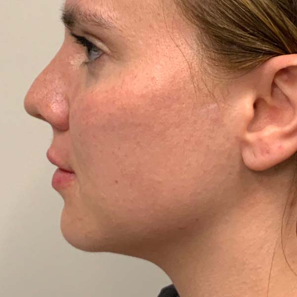 Dermal Fillers 38 After