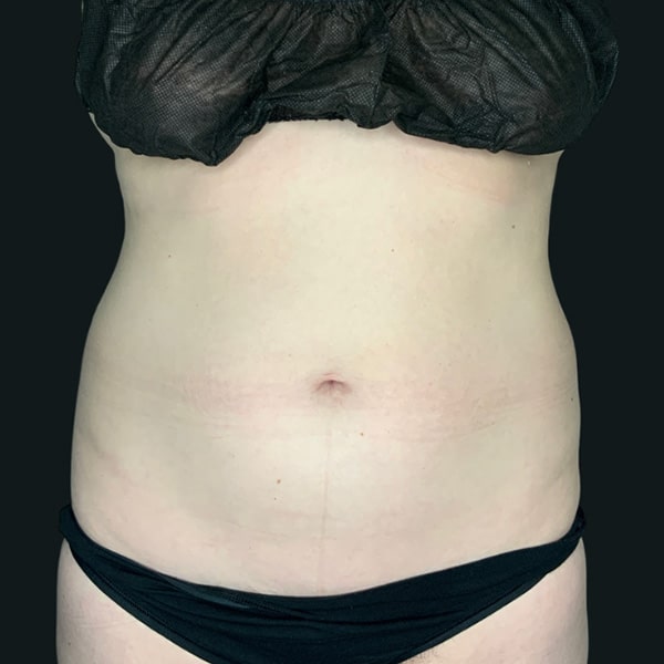 coolsculpting after photo