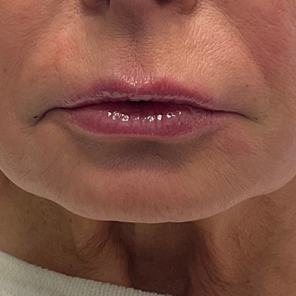 Dermal Fillers 30 After