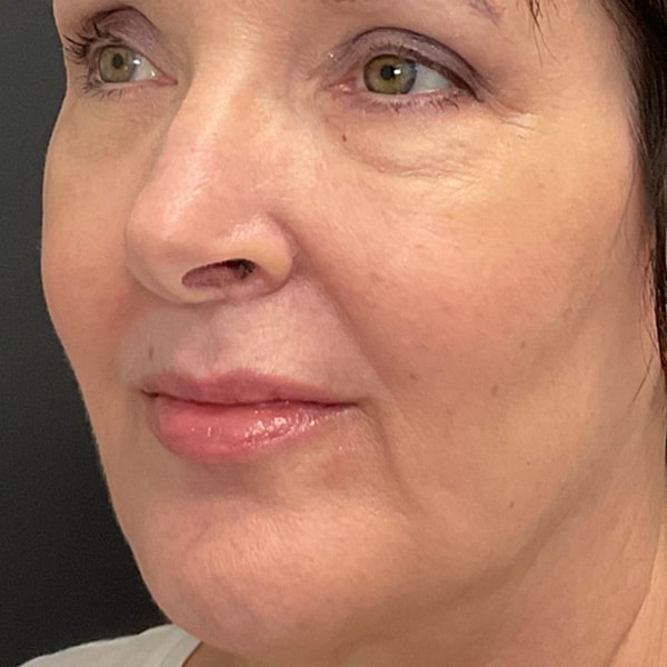 Dermal Fillers 28 After