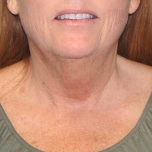 Patient is thrilled to have a tighter neck after her first PDO thread treatment.
