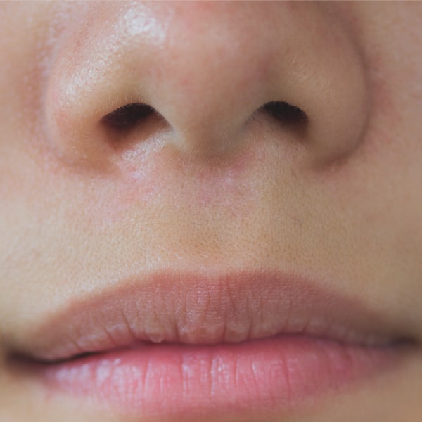 After microneedling treatment woman no longer has scars by her nose.