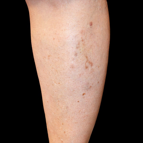 After Sclerotherapy