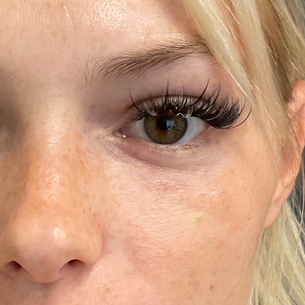 Dermal Fillers 26 After
