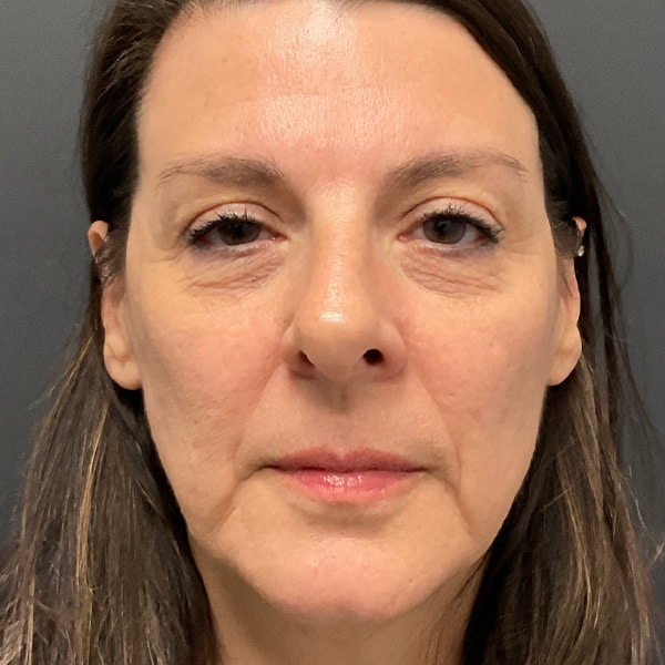 woman AFTER vampire facial from RejuvenationMD
