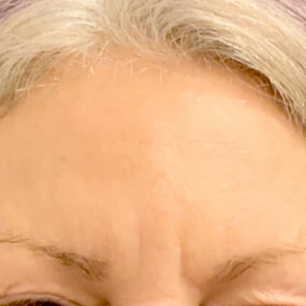 Woman with a smooth forehead after BOTOX.