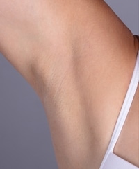 Laser Hair Removal Before and After | After Picture