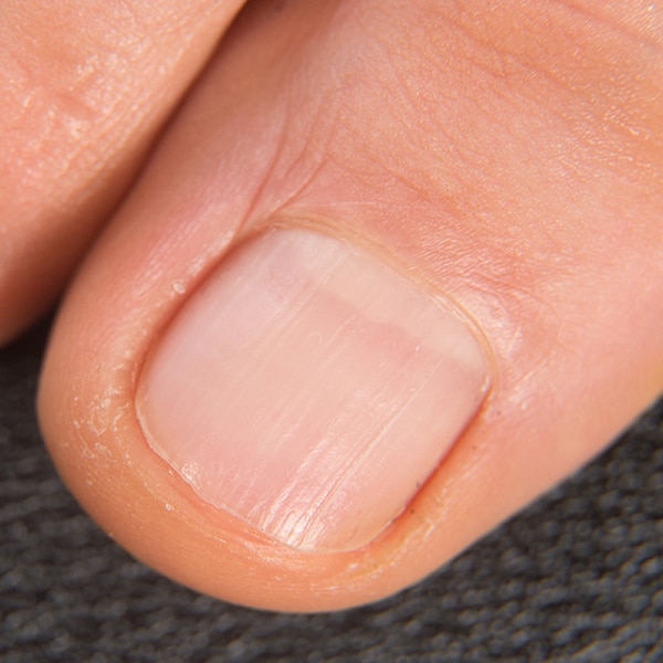 Keys To Diagnosing And Treating Dystrophic Toenails
