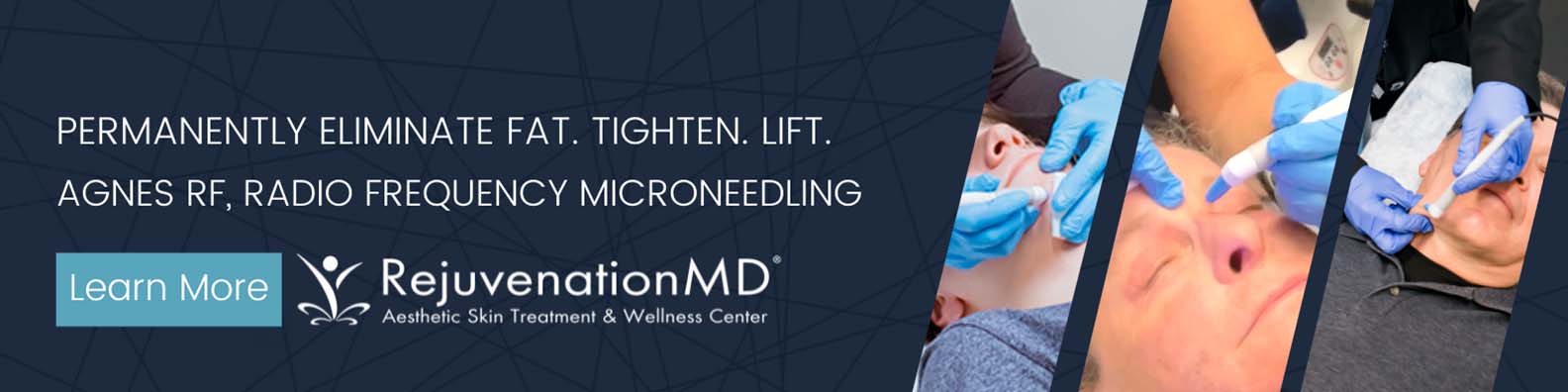 Agnes RF microneedling | RejuvenationMD