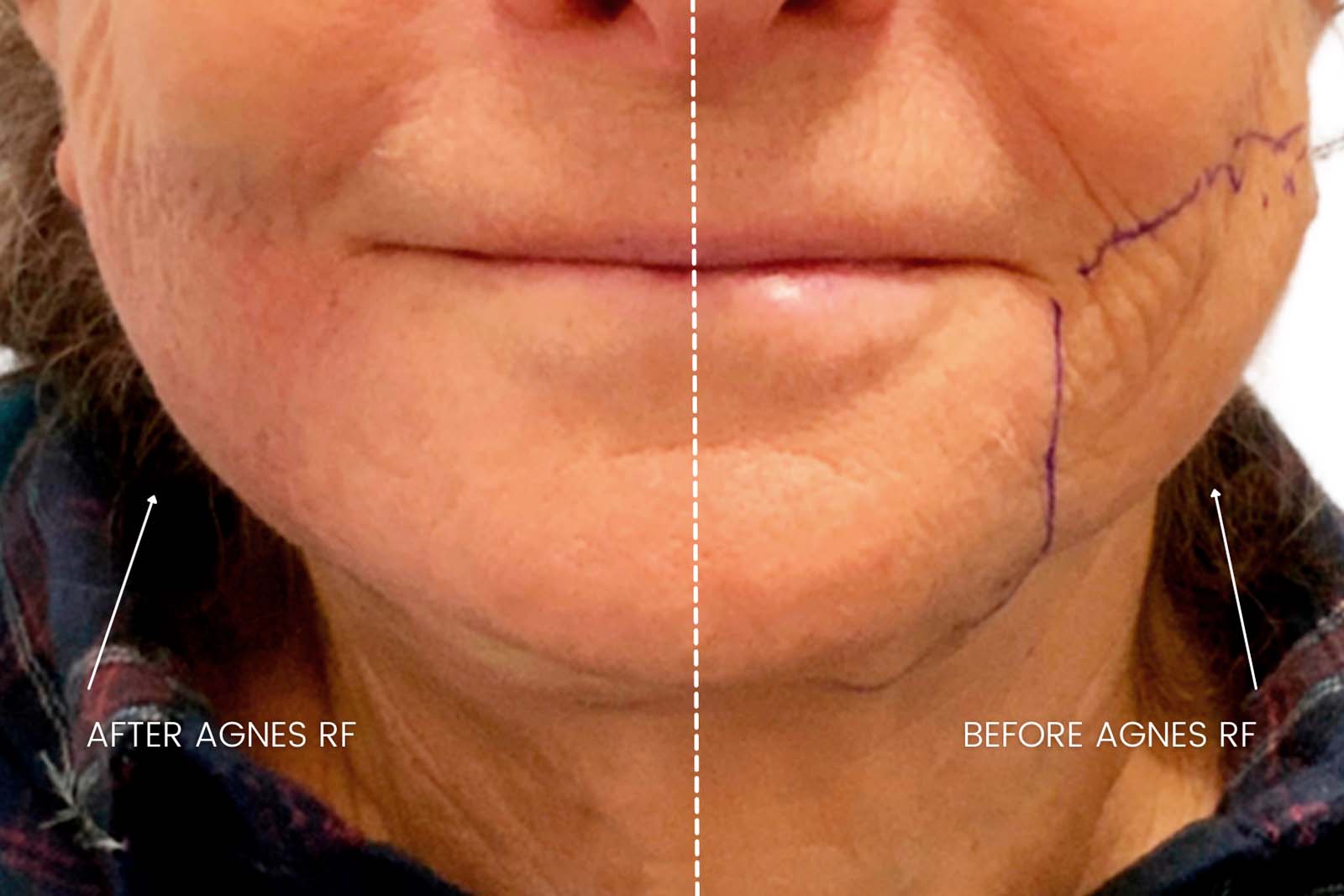 Radio Frequency Microneedling Jowl Fat Elimination with Agnes RF