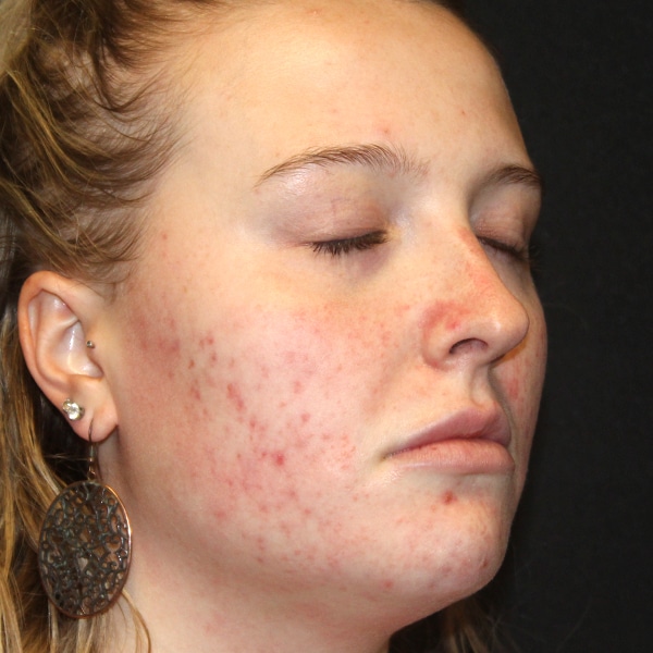 A woman with acne prior to her Agnes RF treatment