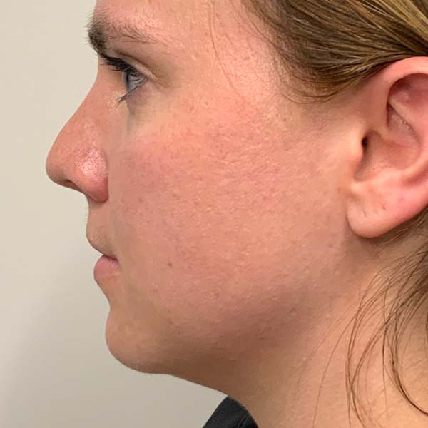 Dermal Fillers 37 Before