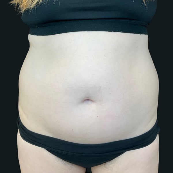 coolsculpting before photo