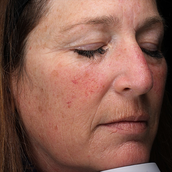 Halo® Pro 3 Halo Laser Before and After | Before Picture