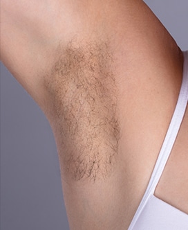 Laser Hair Removal Before and After | Before Picture