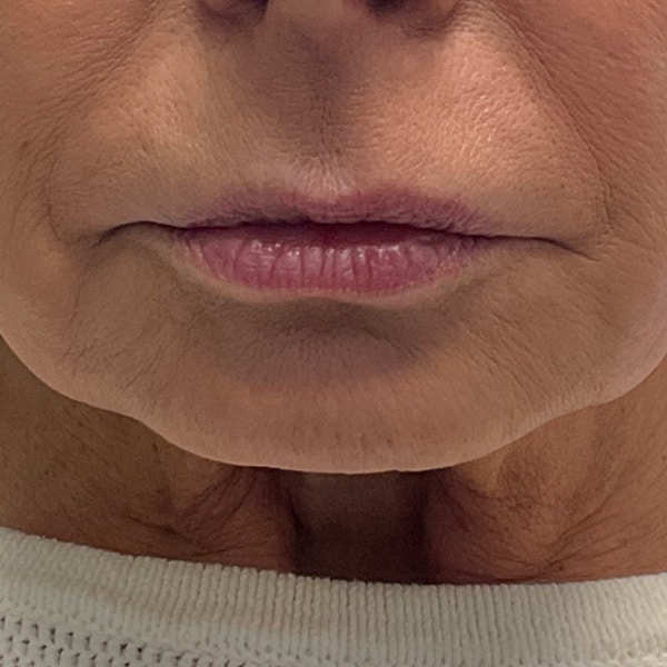 Dermal Fillers 29 Before