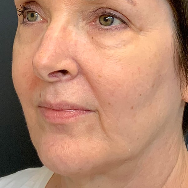 Dermal Fillers 27 Before