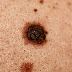 Harmless big mole on man's back.