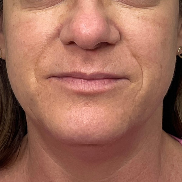 Thread Lift Before and After | Before Picture