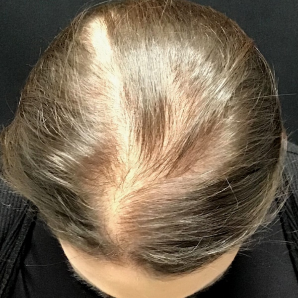 Hair Loss | Med Spa | Bellingham | Burlington | Bothell | RejuvenationMD