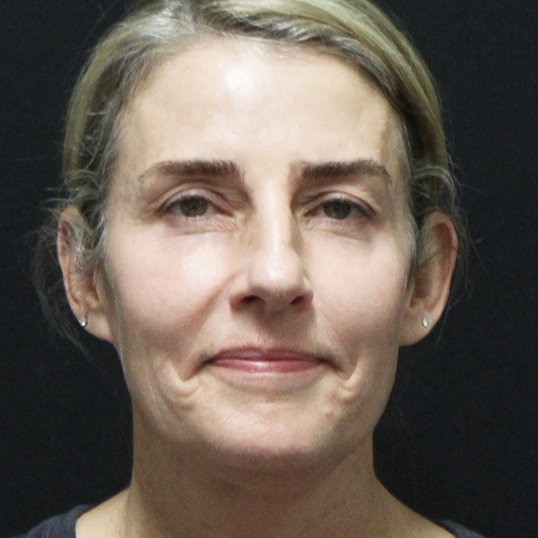 woman looking straight forward with volume in her cheeks after sculptra. She looks markedly younger