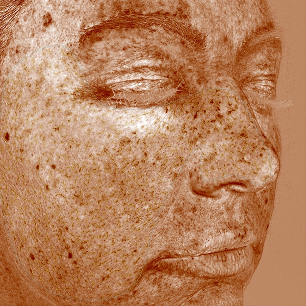 Visia Image shows pigment dense areas in skin caused by sun damage.