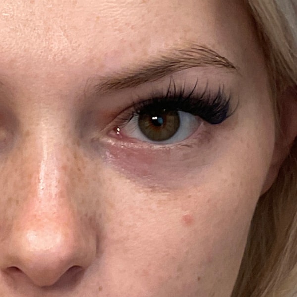Dermal Fillers 25 Before