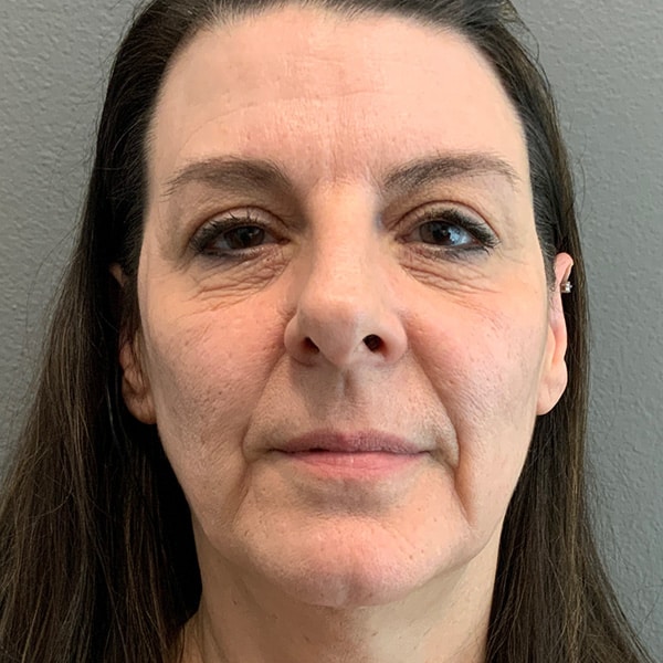 woman before vampire facial from RejuvenationMD