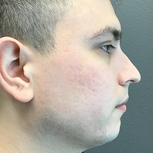 Man with bad acne scarring on cheeks.