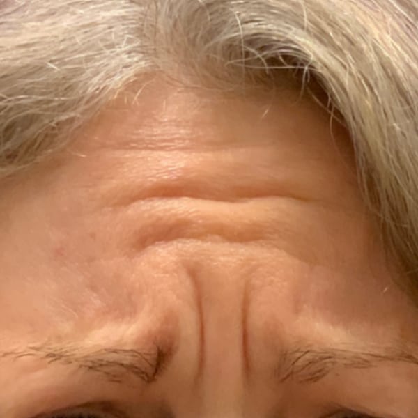 Woman with deep wrinkles in her forehead