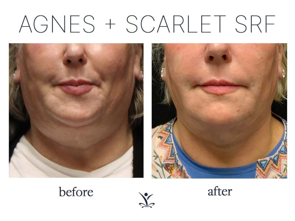 Before and After Agnes RF + Scarlet SRF Double Chin treatment