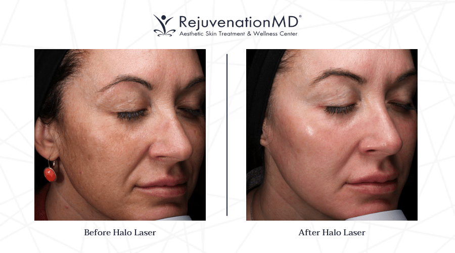What to Expect from a Halo Laser Treatment RejuvenationMD