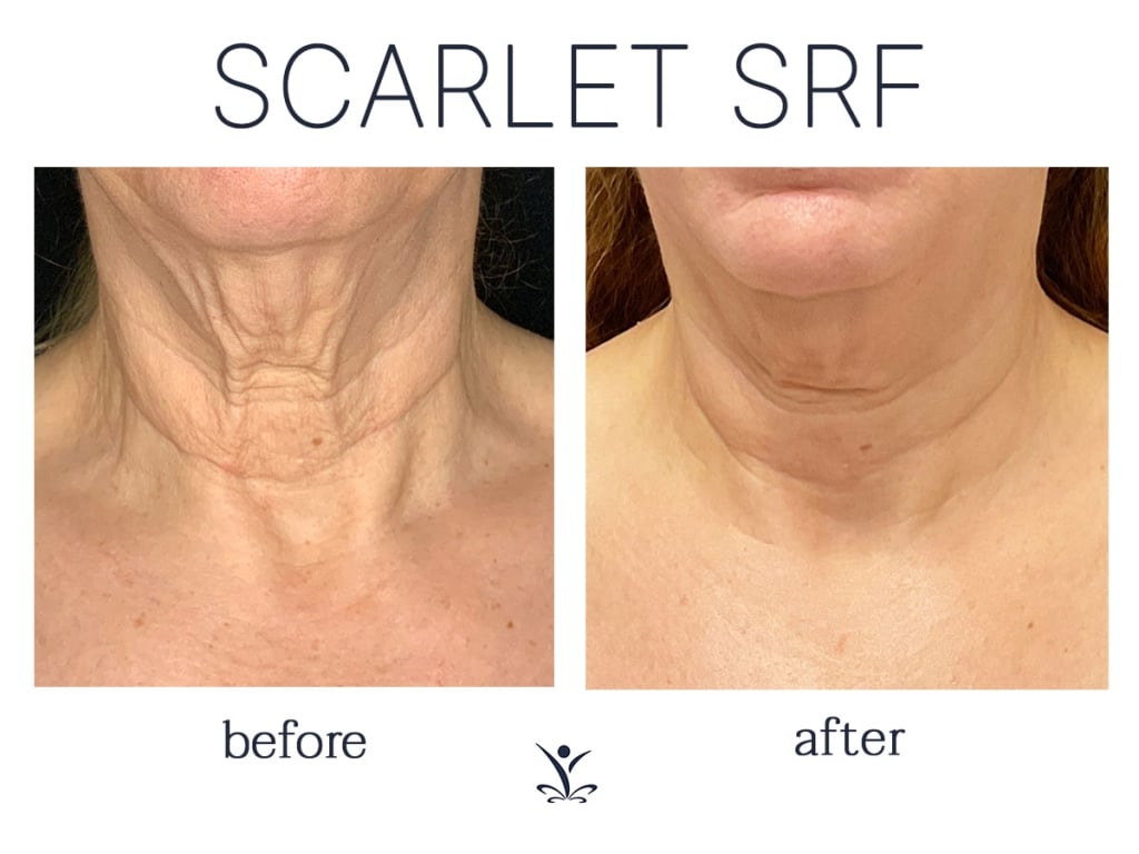 Before and After 6 Scarlet SRF Neck treatments from RejuvenationMD