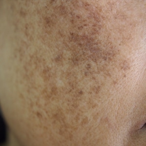 hyperpigmentation