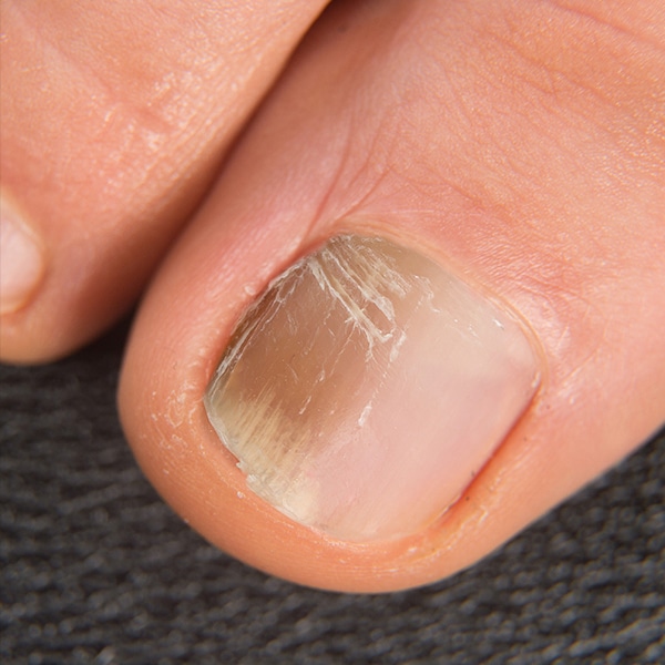 Fungal nails - Intensive night treatment - Poderm